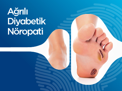 Ağrılı Diyabetik Nöropati